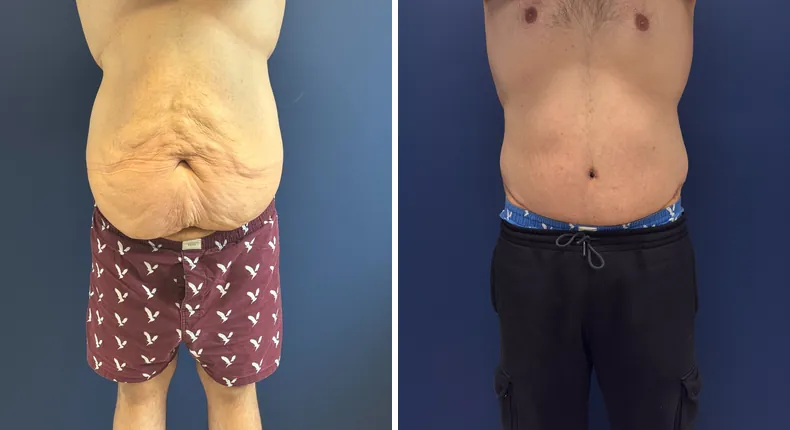 Before and after body lift: man's body