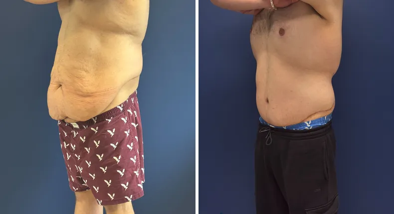 Before and after body lift: man's body