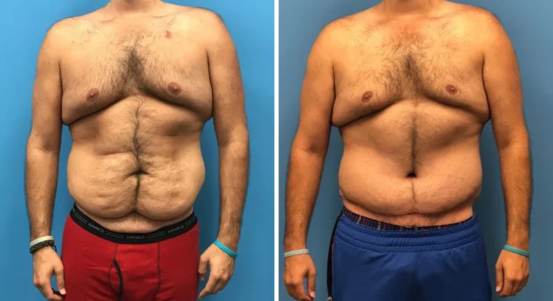 Before and after body lift: man's body