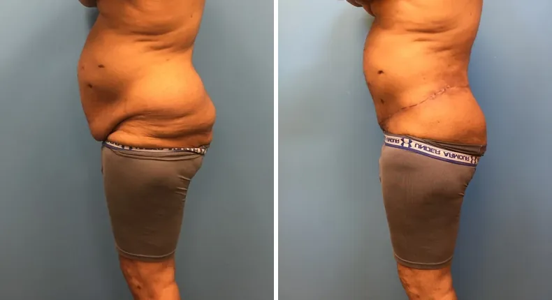 Before and after body lift: patient's body
