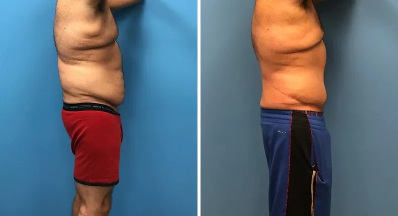 Before and after body lift: man's body