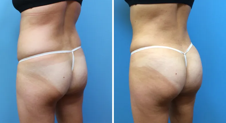 Before and after brazilian butt lift (bbl): patient's buttocks and hips at a left angle