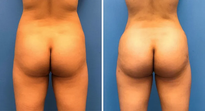 Before and after brazilian butt lift (bbl): patient's buttocks and hips