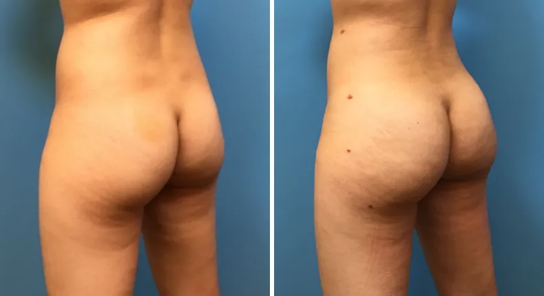 Before and after brazilian butt lift (bbl): woman's buttocks and hips at a left angle