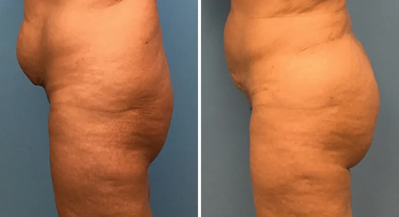 Before and after brazilian butt lift (bbl): patient's buttocks and hips from the left side
