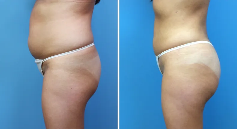 Before and after brazilian butt lift (bbl): patient's buttocks and hips from the left side