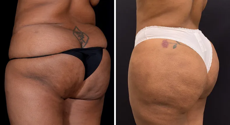 Before and after brazilian butt lift (bbl): patient's buttocks and hips at a left angle