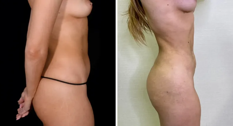 Before and after brazilian butt lift (bbl): patient's buttocks and hips in right profile, with liposuction