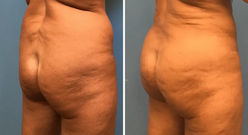 Before and after brazilian butt lift (bbl): patient's buttocks and hips at a right angle