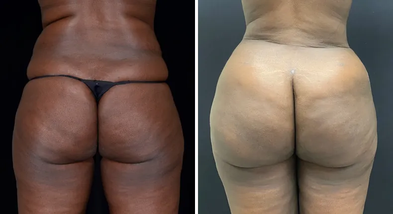 Before and after brazilian butt lift (bbl): patient's buttocks and hips from the back