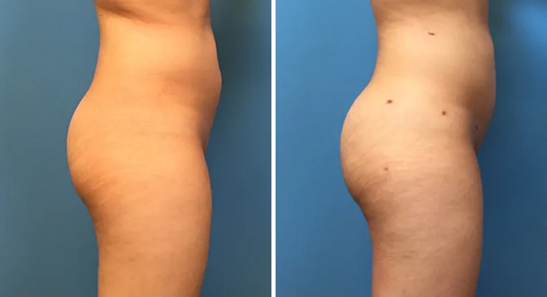 Before and after brazilian butt lift (bbl): woman's buttocks and hips from the right side