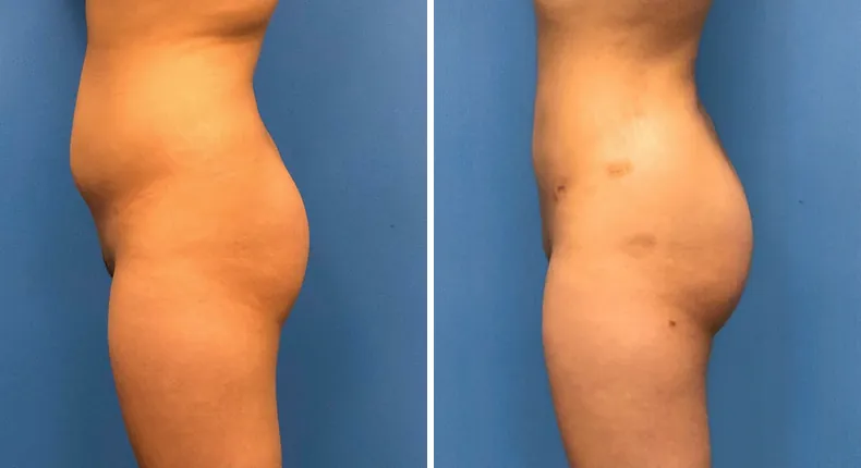 Before and after brazilian butt lift (bbl): patient's buttocks and hips from the left side