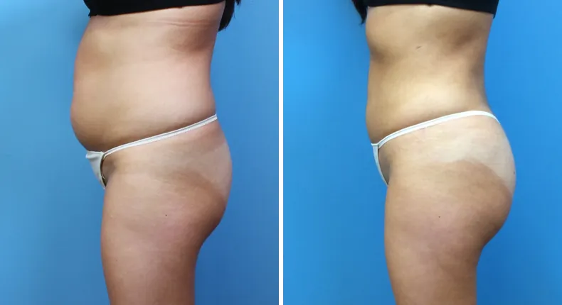 Before and after brazilian butt lift (bbl): patient's buttocks and hips in left profile