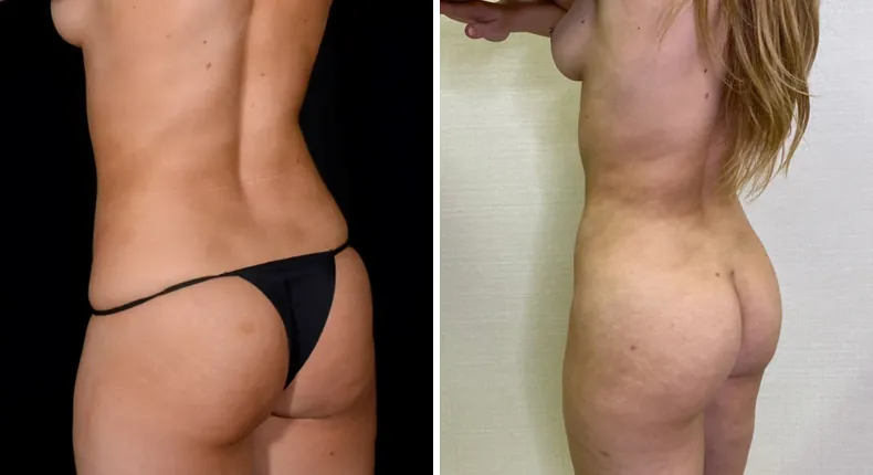 Before and after brazilian butt lift (bbl): patient's buttocks and hips at a left angle, with liposuction