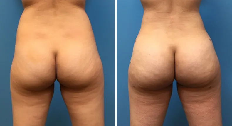 Before and after brazilian butt lift (bbl): woman's buttocks and hips