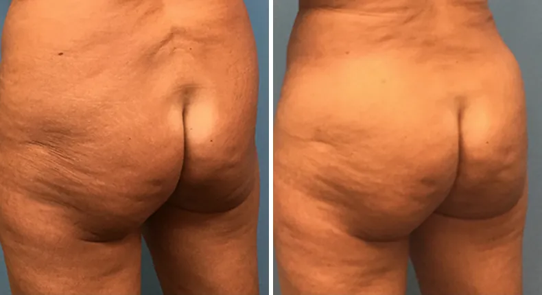 Before and after brazilian butt lift (bbl): patient's buttocks and hips at a left angle