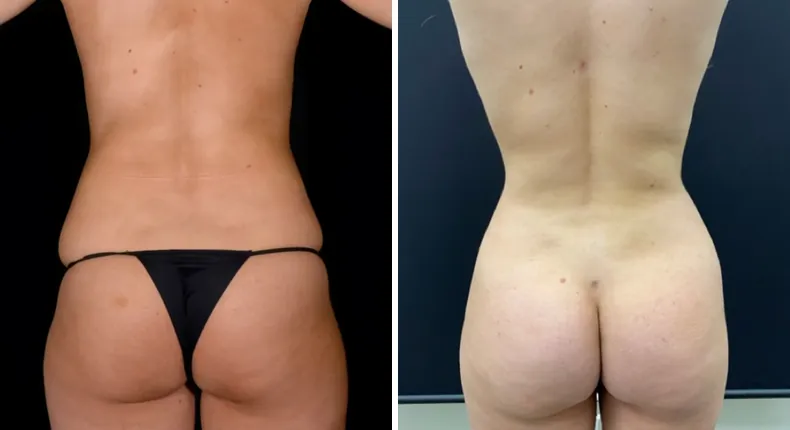 Before and after brazilian butt lift (bbl): patient's buttocks and hips from the back, with liposuction
