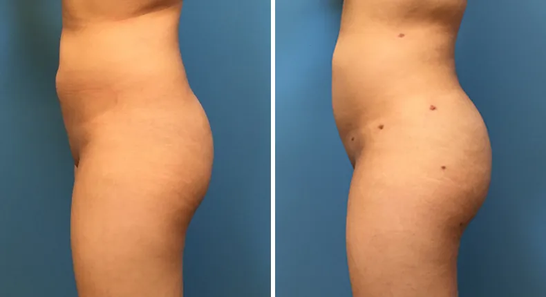 Before and after brazilian butt lift (bbl): woman's buttocks and hips from the left side