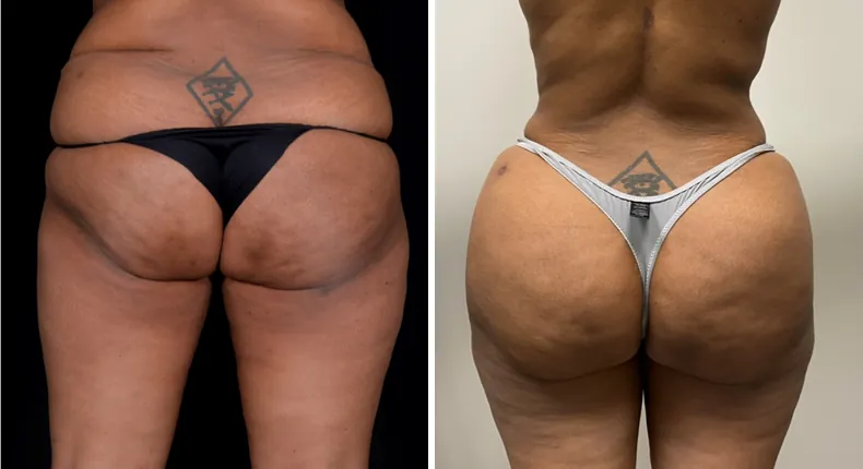 Before and after brazilian butt lift (bbl): patient's buttocks and hips from the back