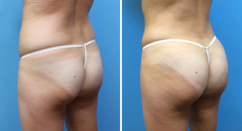 Before and after brazilian butt lift (bbl): patient's buttocks and hips at a left angle