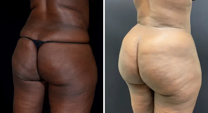 Before and after brazilian butt lift (bbl): patient's buttocks and hips at a right angle