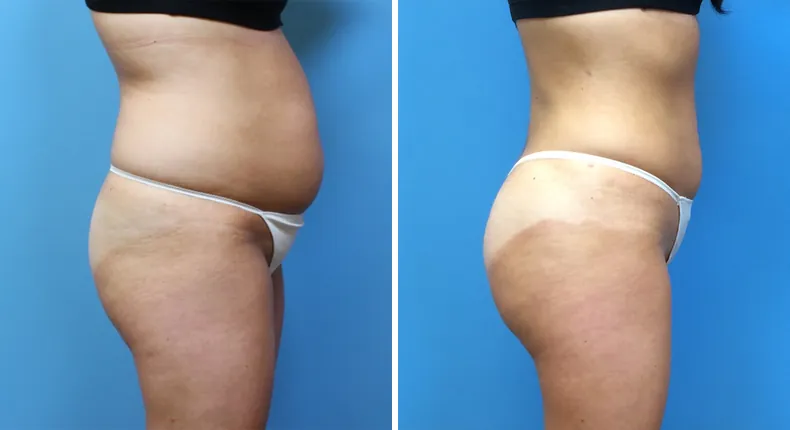 Before and after brazilian butt lift (bbl): patient's buttocks and hips in right profile