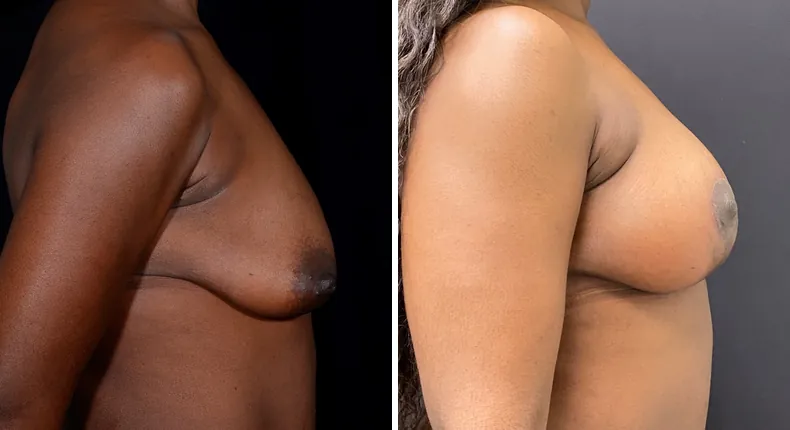 Before and after breast augmentation with lift: patient's breasts from the right side