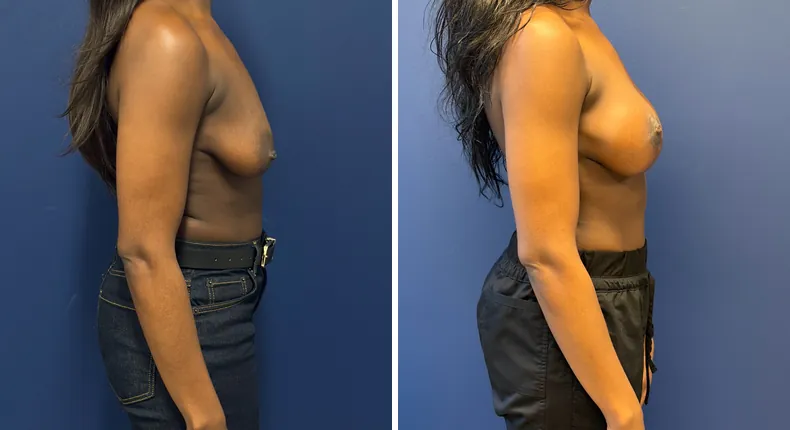 Before and after breast augmentation with lift: woman's breasts, with preserve breast augmentation