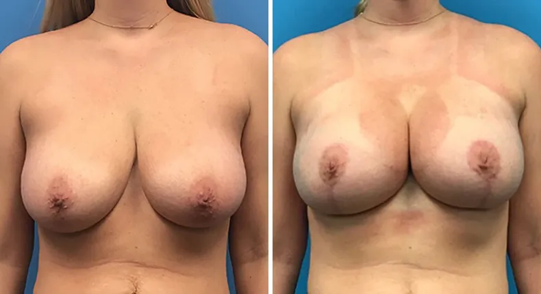 Before and after breast augmentation with lift: patient's breasts from the front