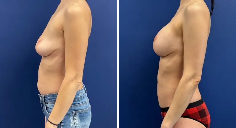 Before and after breast augmentation with lift: patient's breasts from the left side