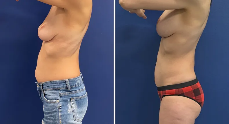 Before and after breast augmentation with lift: patient's breasts from the left side