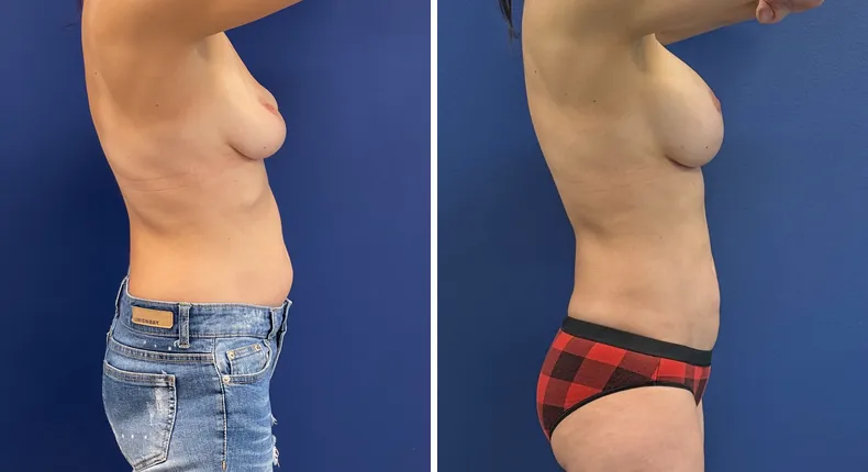Before and after breast augmentation with lift: patient's breasts from the right side