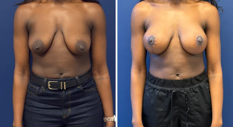 Before and after breast augmentation with lift: woman's breasts, with preserve breast augmentation