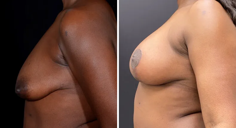 Before and after breast augmentation with lift: patient's breasts from the left side