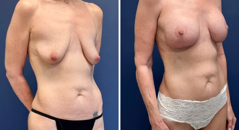 Before and after breast augmentation with lift: patient's breasts from the right side