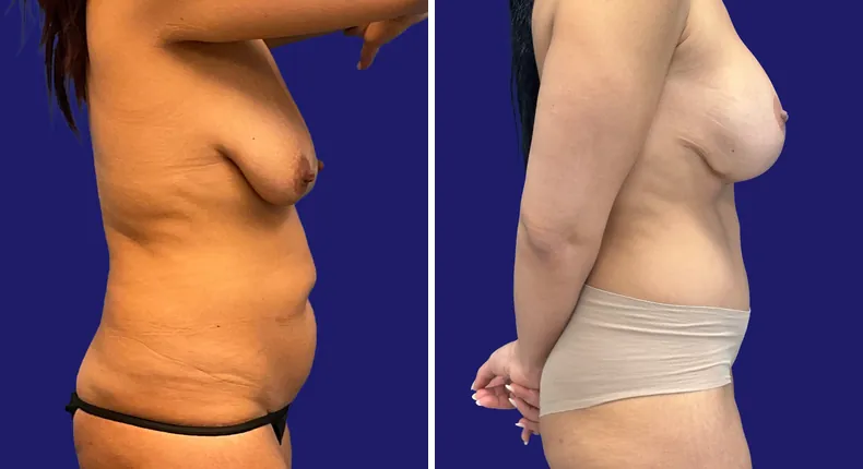 Before and after breast augmentation with lift: woman's breasts, with breast augmentation, breast lift, liposuction, tummy tuck and mommy makeover