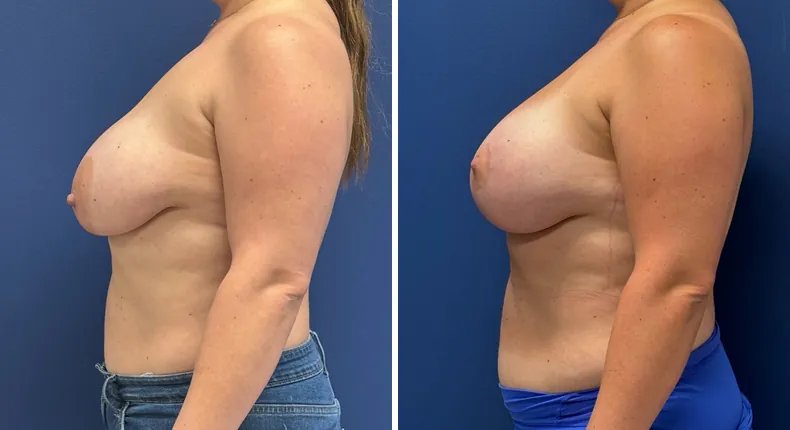Before and after breast augmentation with lift: patient's breasts from the left side