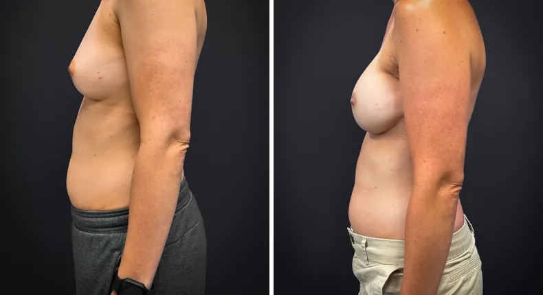 Before and after breast augmentation with lift: patient's breasts from the left side