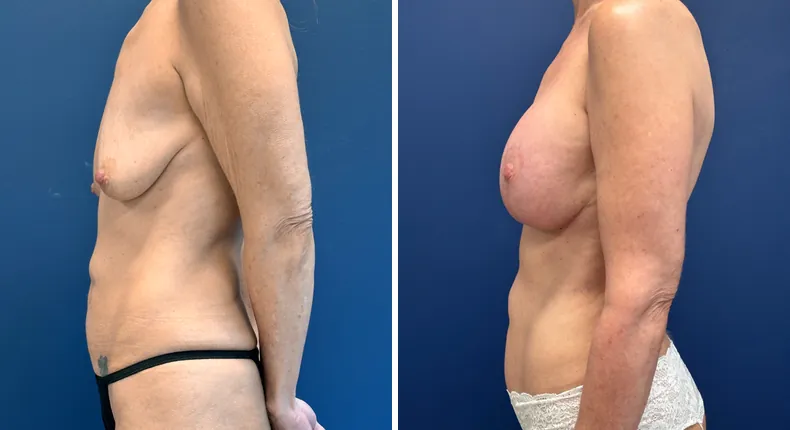 Before and after breast augmentation with lift: patient's breasts in left profile