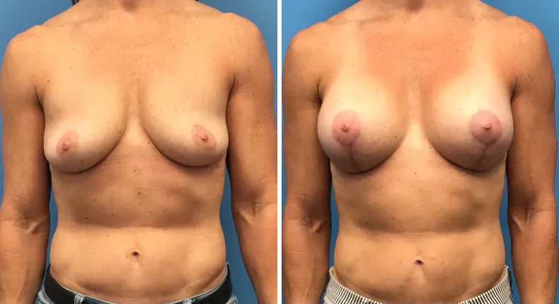 Before and after breast augmentation with lift: patient's breasts