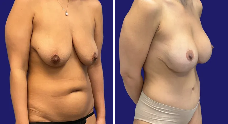 Before and after breast augmentation with lift: woman's breasts, with breast augmentation, breast lift, liposuction, tummy tuck and mommy makeover
