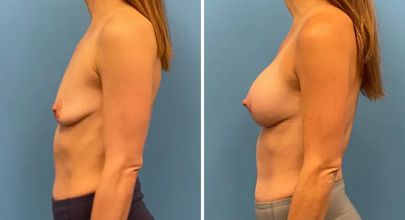 Before and after breast augmentation with lift: patient's breasts from the left side