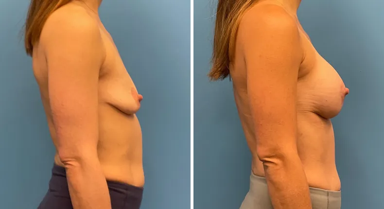 Before and after breast augmentation with lift: patient's breasts from the right side