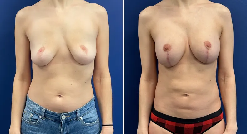 Before and after breast augmentation with lift: patient's breasts from the front