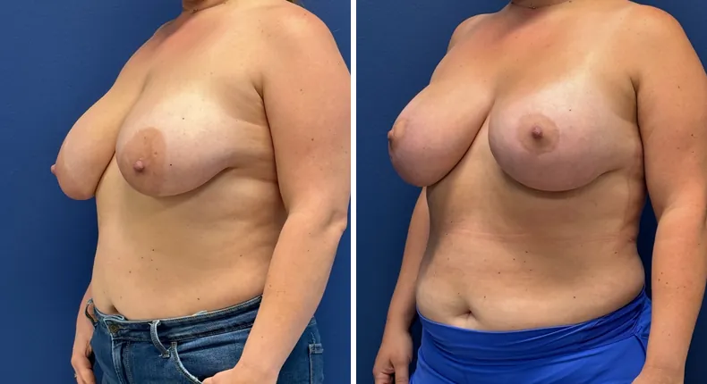 Before and after breast augmentation with lift: patient's breasts at a left angle