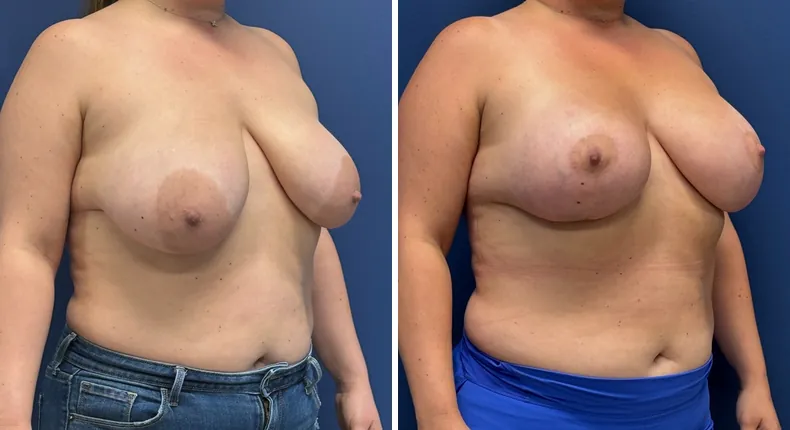 Before and after breast augmentation with lift: patient's breasts at a right angle