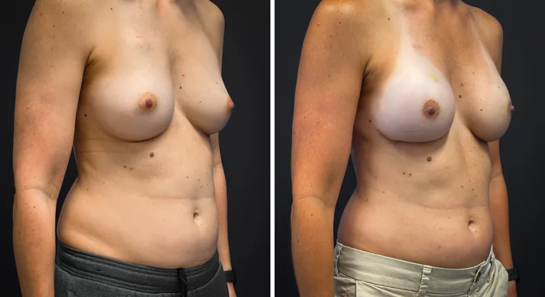 Before and after breast augmentation with lift: patient's breasts at a right angle