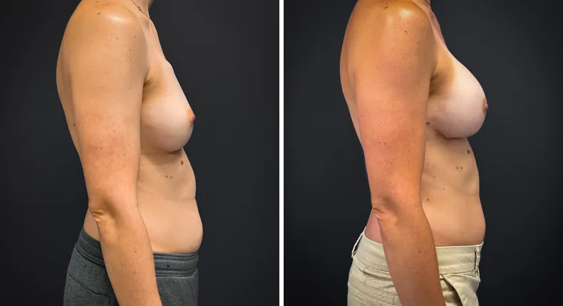 Before and after breast augmentation with lift: patient's breasts from the right side