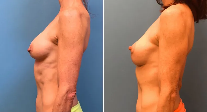 Before and after breast augmentation with lift: patient's breasts from the left side