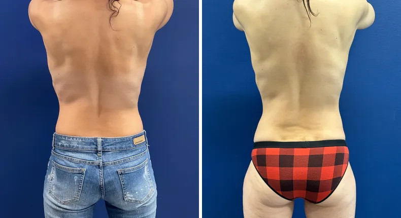 Before and after breast augmentation with lift: patient's breasts from the back